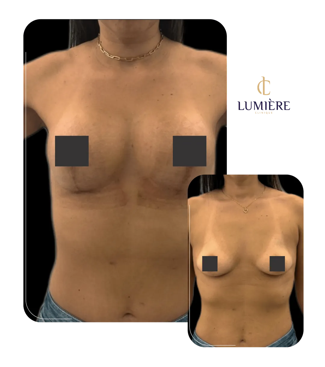 Resultado real de paciente da Lumière