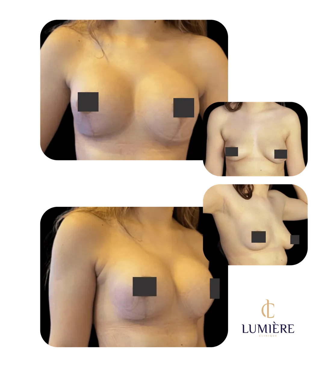 Resultado real de paciente da Lumière